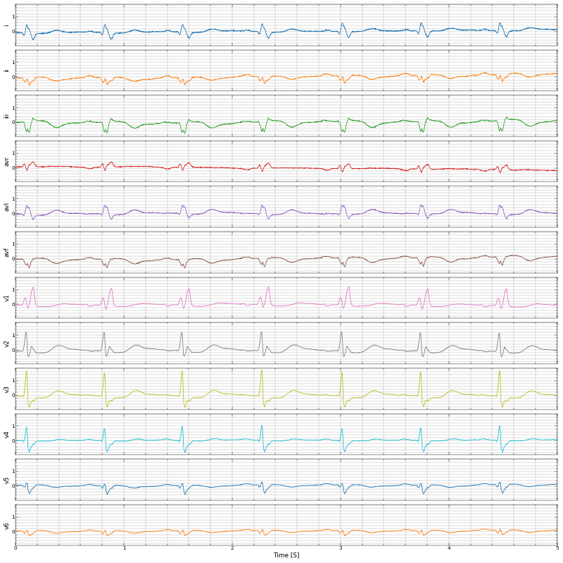 EKG for MI